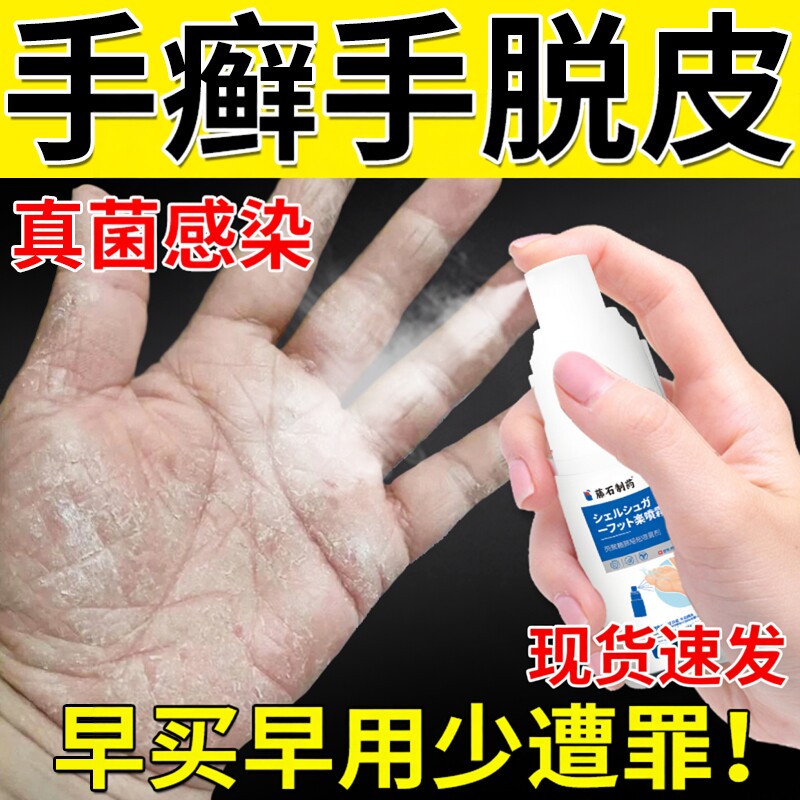 手癣膏脱皮干裂开裂真菌感染鹅掌风手藓手气痒药房同款专用喷剂JW
