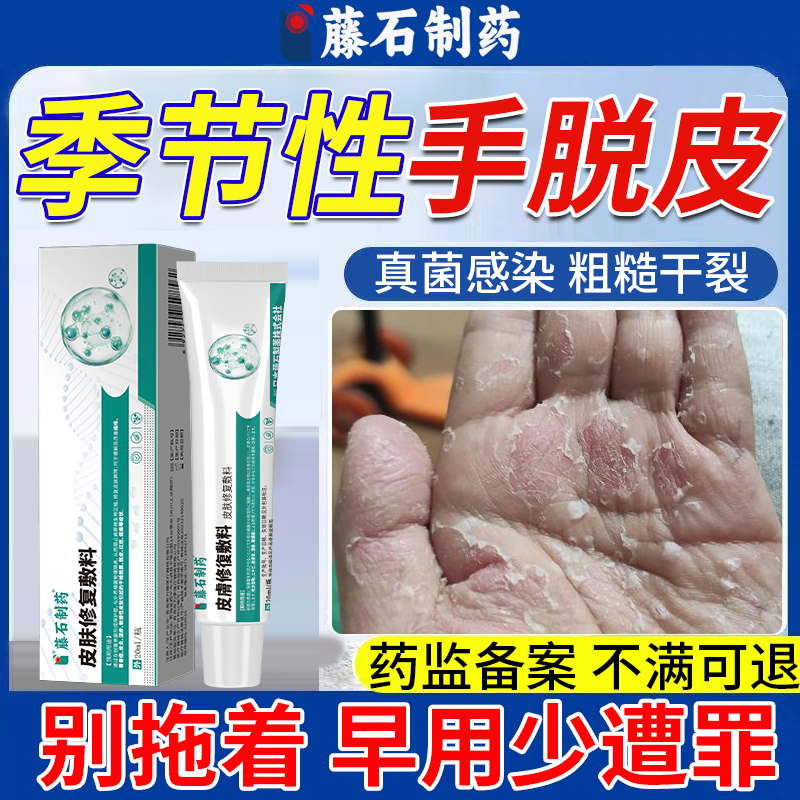 手脱皮干裂真菌感染严重季节性专用剥脱性角质松懈症维生素儿童OZ