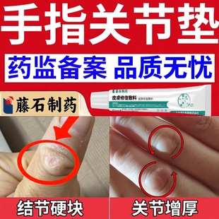 手指关节癣变形肿粗大去指节垫可搭药膏手上长硬疙瘩修复增厚OZ