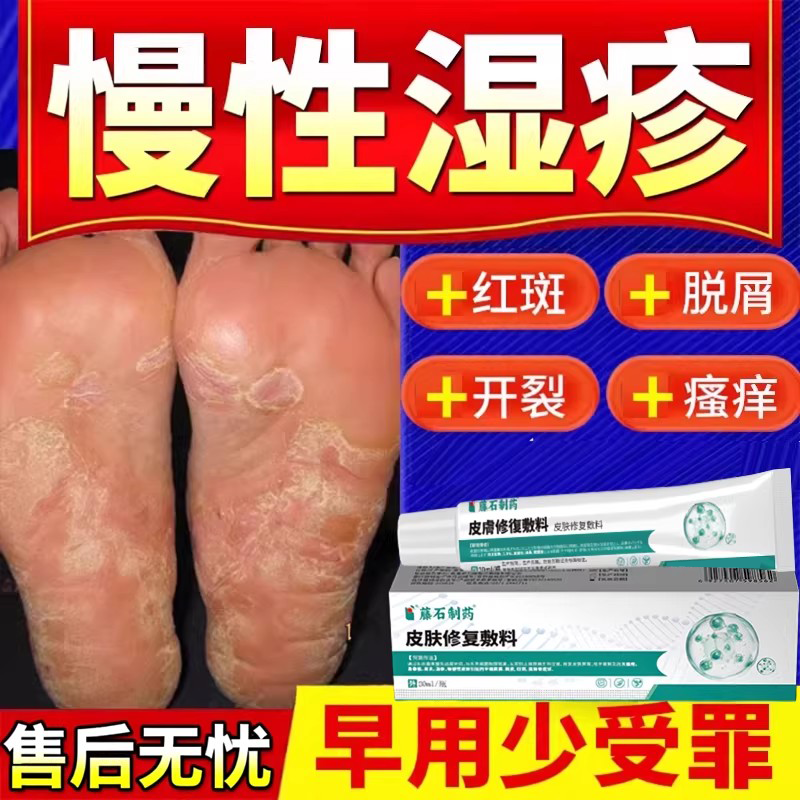 慢性湿疹止痒去外用顽固皮炎脚底脚部湿诊根脚气脚癣真菌感染痒DZ