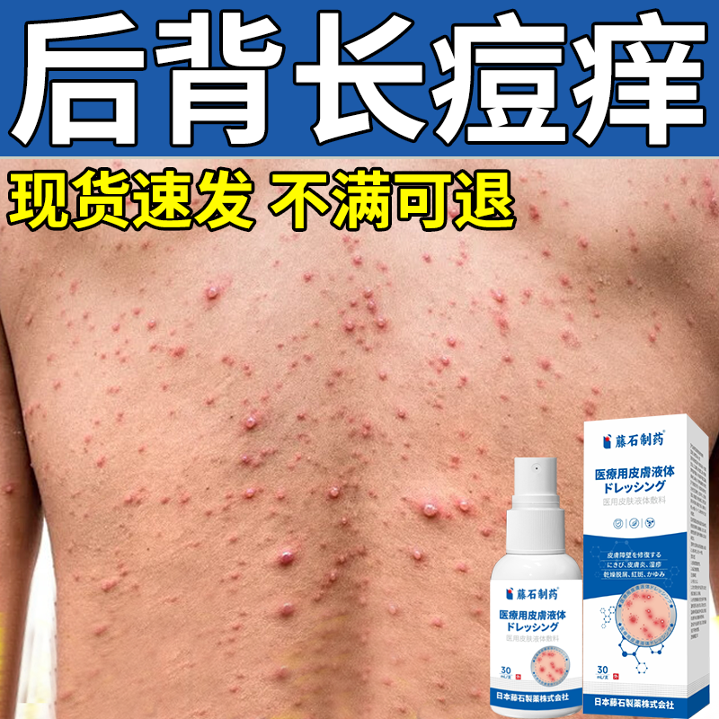 后背长痘痘瘙痒专用喷剂
