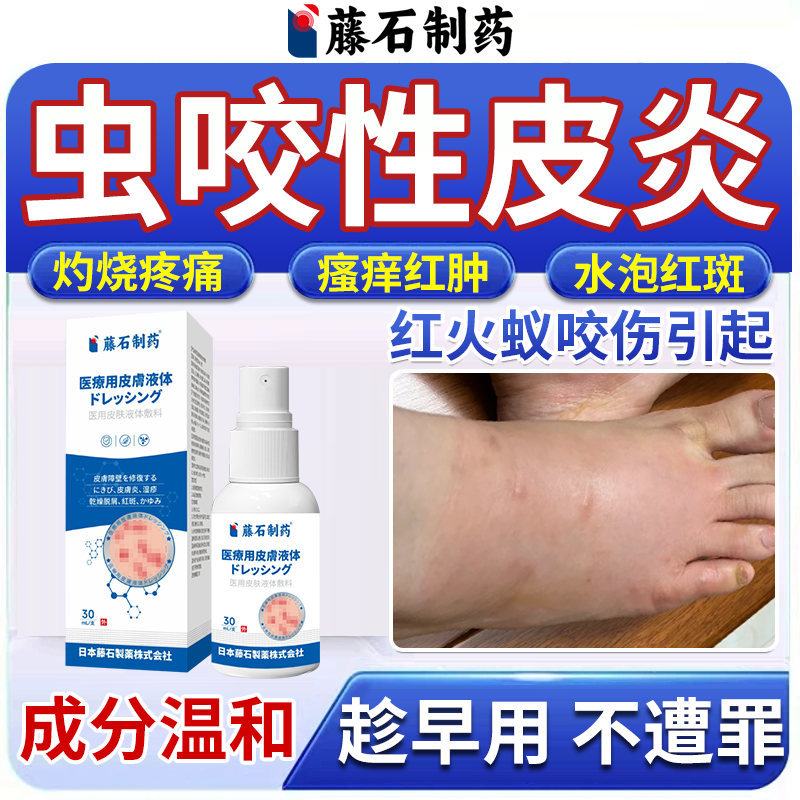 红火蚁叮咬止痒消肿皮炎喷剂