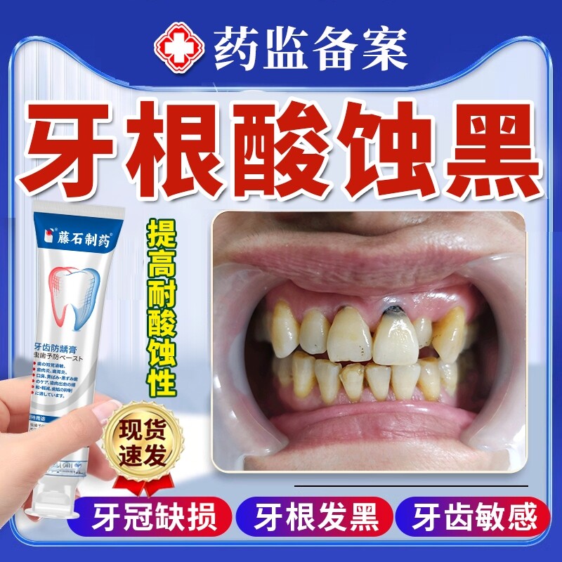 牙齿酸蚀牙根腐蚀变黑脱矿釉质楔状缺损修黑斑去除复含氟搭牙膏JW