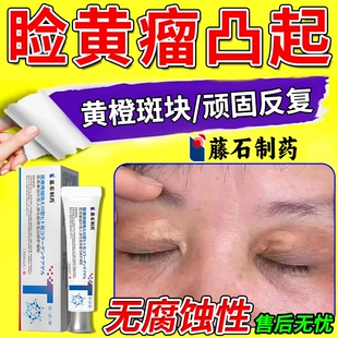 眼部眼睑黄疣睑黄瘤去除神器去眼皮黄斑瘤搭专用日本薬房同款膏DZ