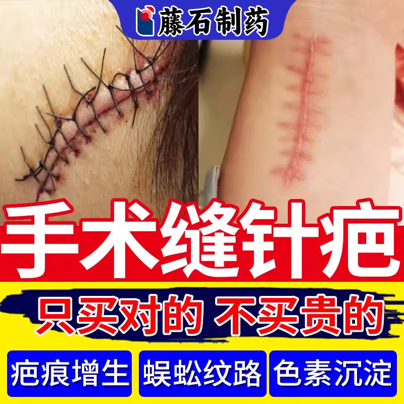 手术缝针疤痕除疤膏增生凸起修去除疙瘩恢复术后减张贴医用复EM