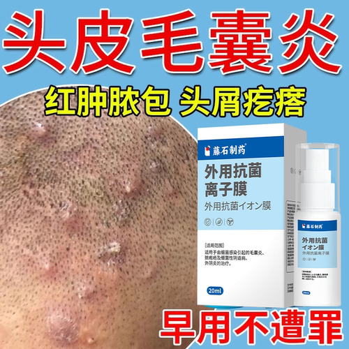 头皮毛囊炎真菌感染膏
