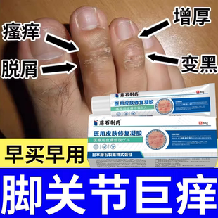 脚关节湿疹长癣脚趾脚指脚部手指脚癣脚气角化型真菌感染脱皮痒BS