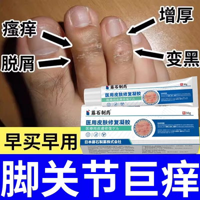 【脚关节增厚脱皮痒】不满可退