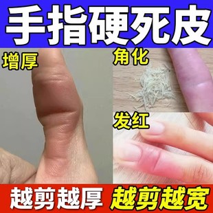 软化手指硬皮角质软化剂拇指去死皮老茧硬茧膏指甲边缘茧子神器BS