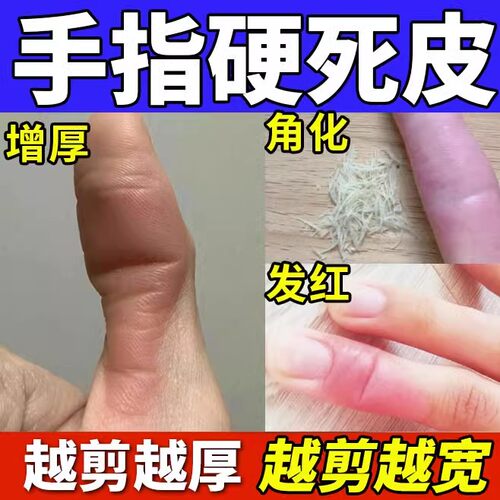 软化手指硬皮角质软化剂拇指去死皮老茧硬茧膏指甲边缘茧子神器BS