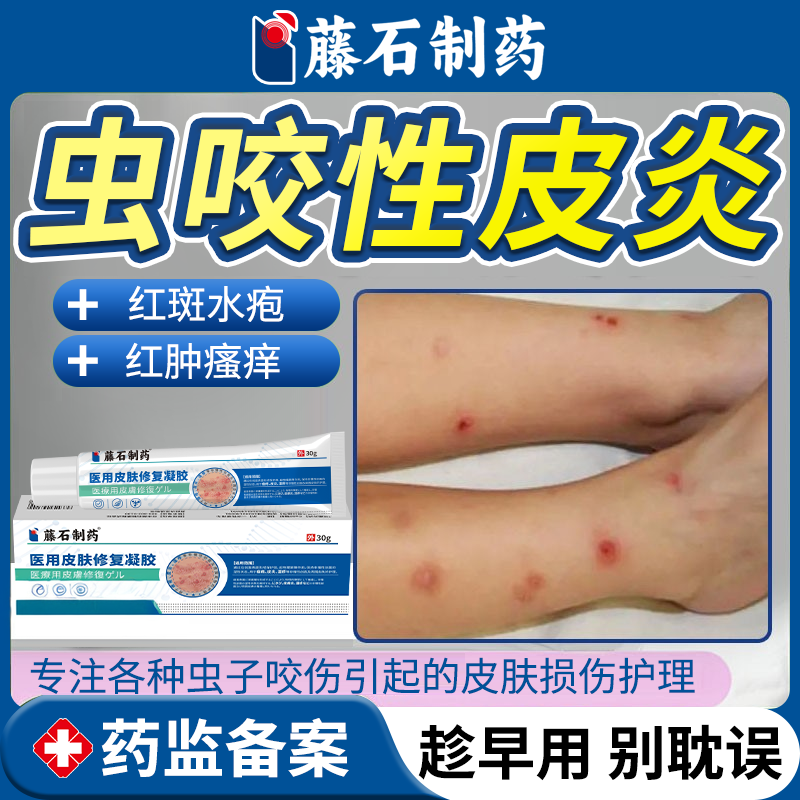 虫咬性皮炎被虫子咬丘疹性荨麻疹止痒喷雾毒虫蚊虫叮咬止痒消肿EM