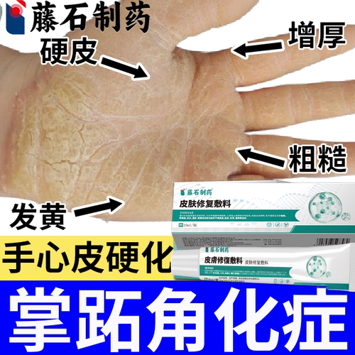 掌跖角化症手掌心增厚发黄硬皮干裂专脚趾脓包病脱皮药监备案膏OZ