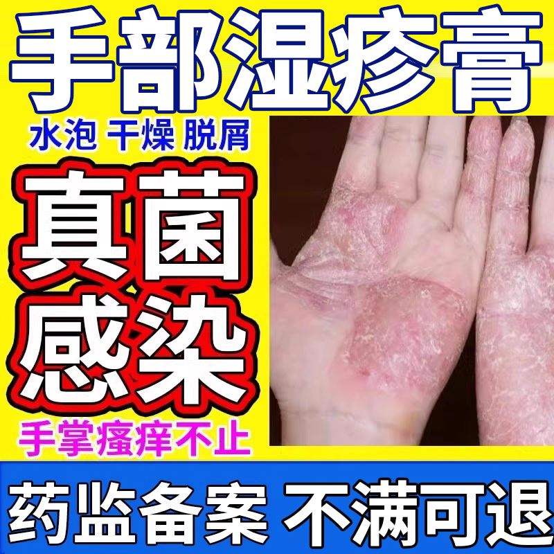 手癣膏脱皮干裂真菌感染