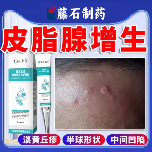 【皮脂腺增生】脸上小丘疹