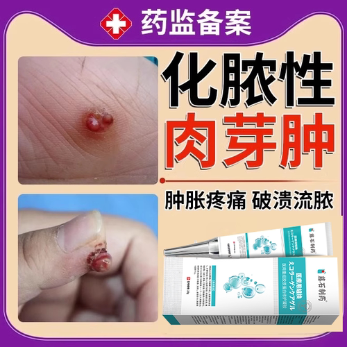 手指长肉芽肿痛破溃流脓