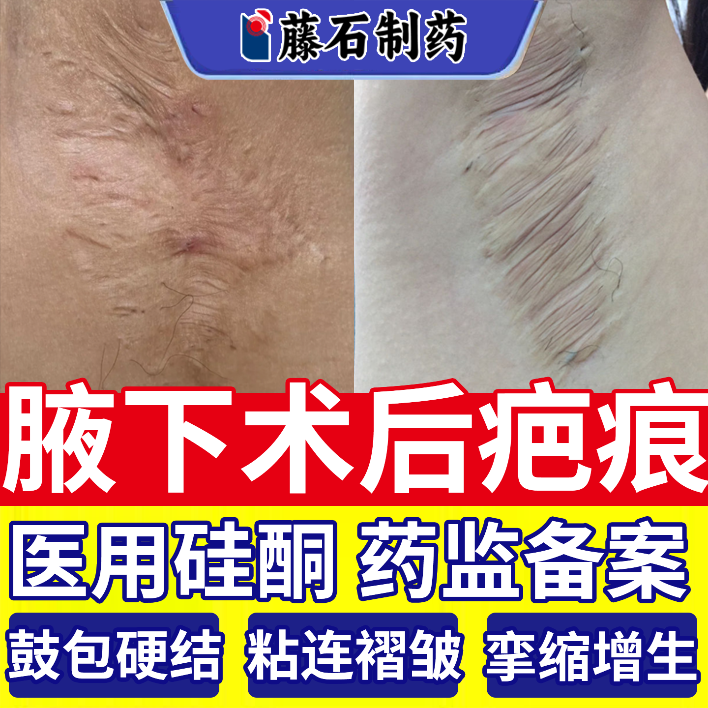 【医用级别】腋下术后疤痕祛疤膏