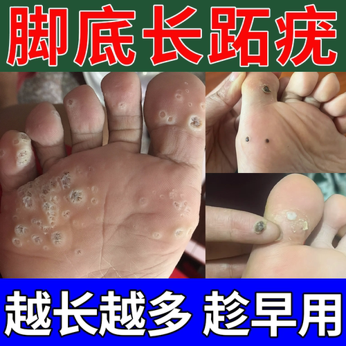 【剥离脱落】脚底跖疣去除贴