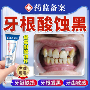 牙齿酸蚀牙根腐蚀变黑脱矿釉质楔状缺损修黑斑去除复含氟搭牙膏JW