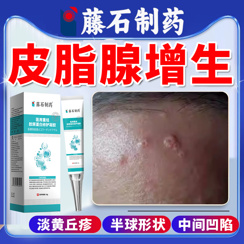 皮脂腺增生增大面部胸前囊肿丘疹肚脐样凹陷早熟性老年性小疙瘩OZ