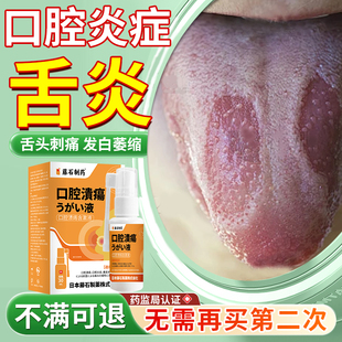 舌炎舌头专用喷雾药房同款裂纹有齿痕舌康灵白苔厚裂痕灼伤上火YY