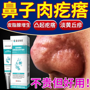 鼻子上肉疙瘩皮脂腺增生异位症分泌旺盛膏藤石制药面部鼻翼脸上YS