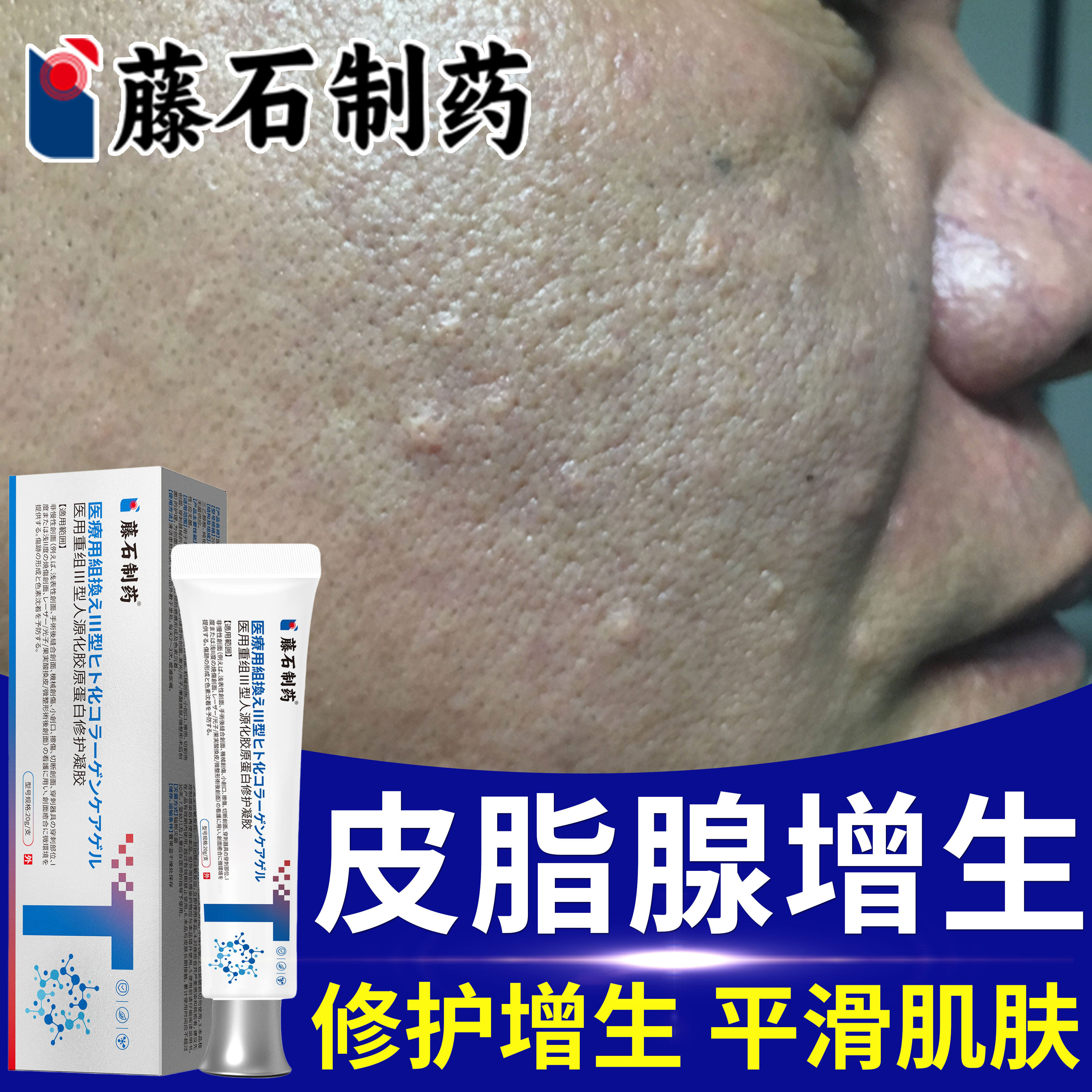 皮脂腺增生增大面部脸部鼻子小疙瘩囊肿修复专用软膏药房同售膏WQ