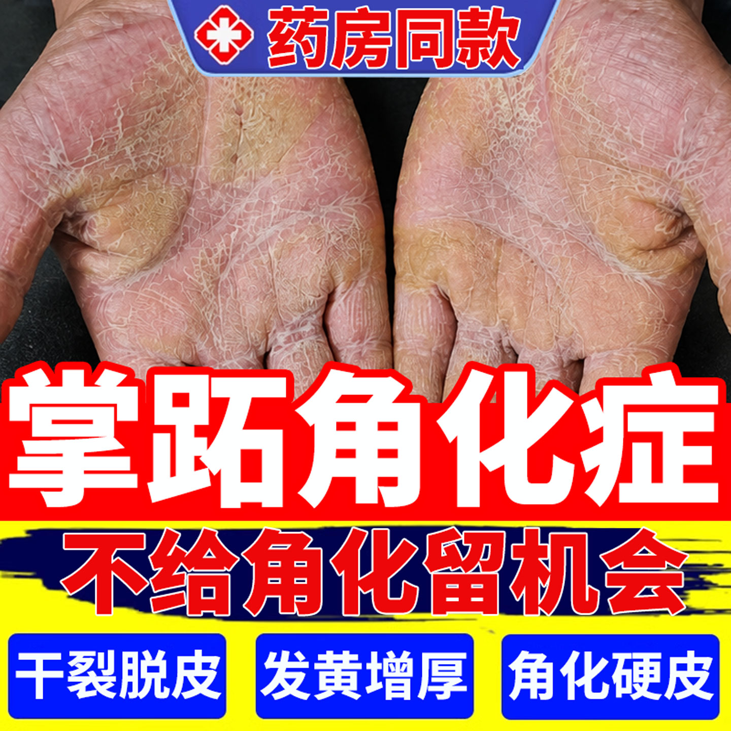 掌跖角化症专用膏角化型手部湿疹发黄增厚脱硬皮药房掌趾脓疱病YZ