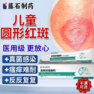 儿童铜钱癣藓体癣真菌感染专用皮肤瘙痒红斑去癣外用药房同款膏YS