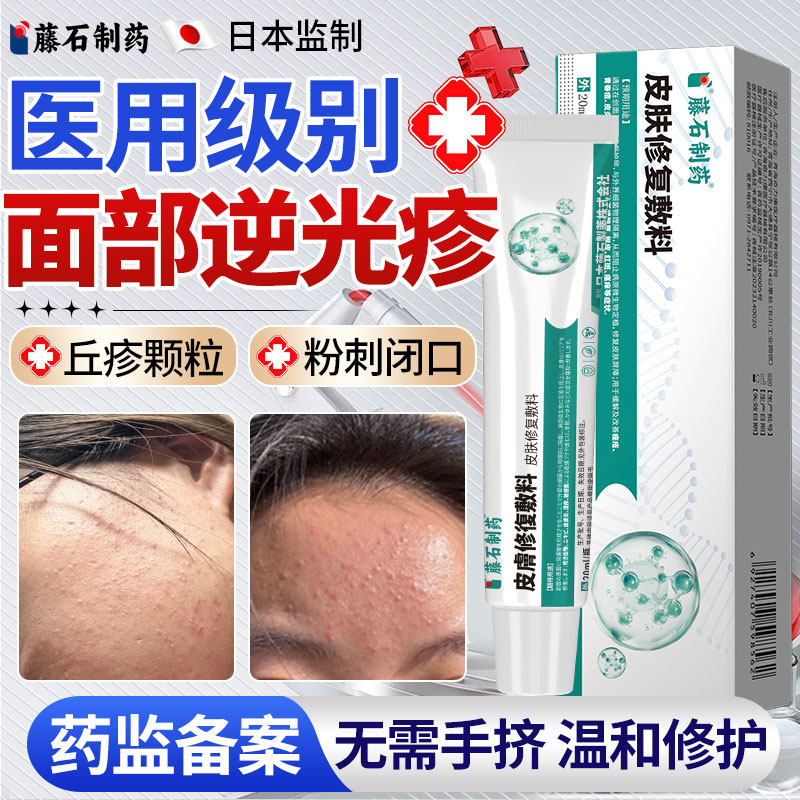 逆光疹屏障修复脸长起小疙瘩闭口粉刺的克星去除脸部去额头痘痘YZ
