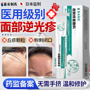 逆光疹屏障修复脸长起小疙瘩闭口粉刺的克星去除脸部去额头痘痘YZ