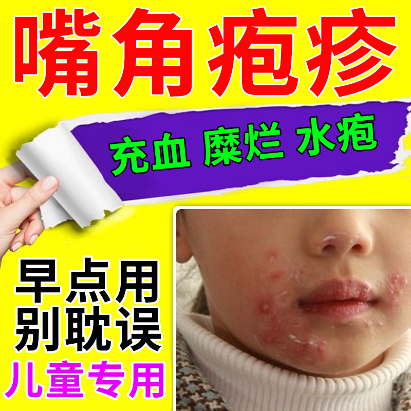 儿童嘴上起水泡专用嘴唇嘴巴烂嘴角疱疹上火起泡唇炎药房同售膏pe