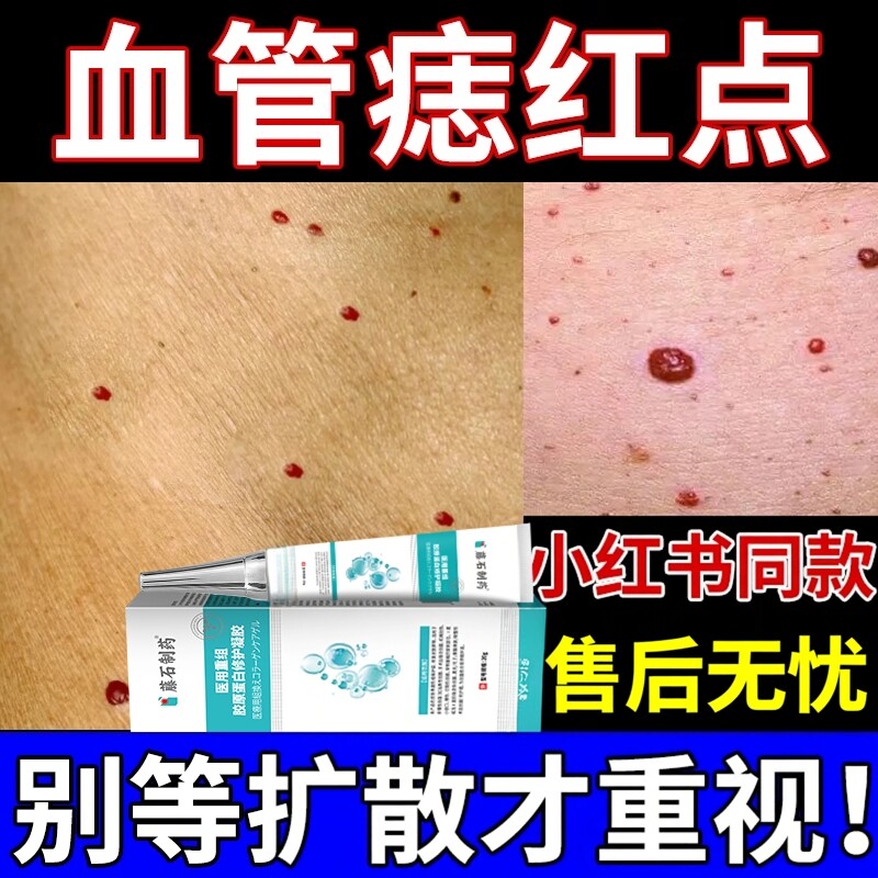 血管痣去除膏藤石制药血管瘤血痣凝胶敷贴点红痣长小红点樱桃状YS
