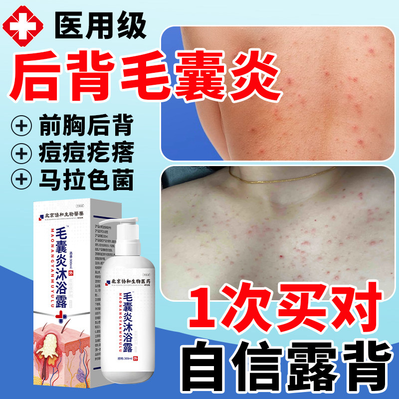 背上长痘痘后背毛囊炎沐浴露马拉色菌毛囊炎鸡皮肤背后痤疮疙瘩yq