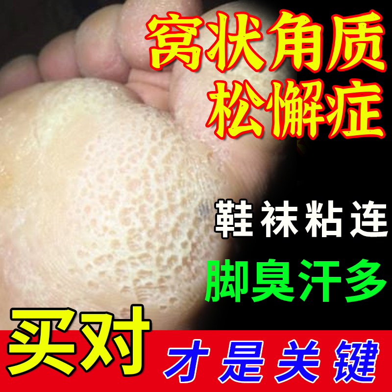 窝状角质松解症脚底起泡蜂窝状沙虫脚糜烂臭脚可搭角质型药膏用wy