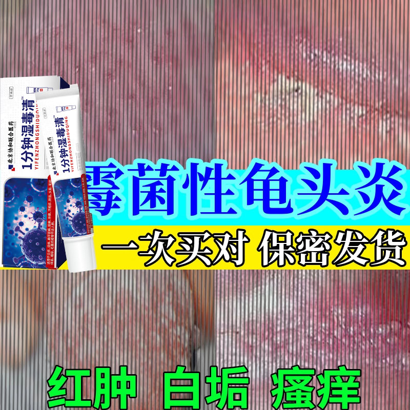 男性龟头炎症专用霉菌性包皮炎裂口白垢豆腐渣真菌感染红肿发炎ro