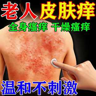 专治皮肤痒的否药老年人皮肤痒止老人全身干痒身上起红疙瘩血热