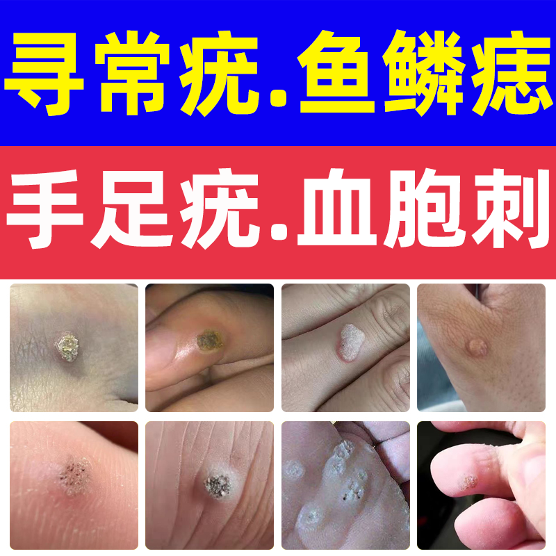 手足疣寻常疣脚底鱼鳞痣鱼休子