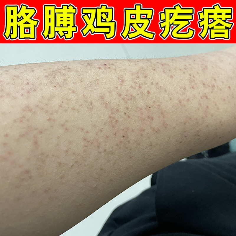 手臂鸡皮疙瘩毛囊毛周角化去除胳膊腿上黑点角质毛孔堵塞专用