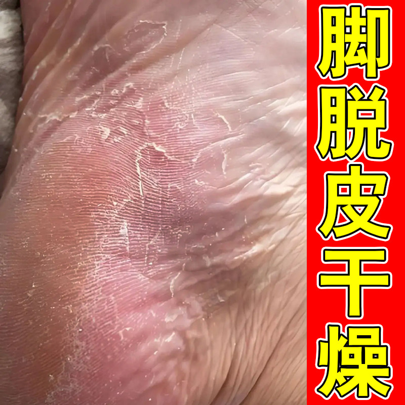 脚脱皮专用膏外用脚干燥粗糙起皮掉屑脚后跟干裂修复霜脚掉皮脚痒