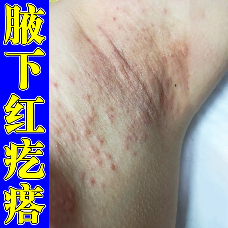 腋下毛囊出汗红汗渍发红胳肢窝红肿马拉色菌腋下淹红