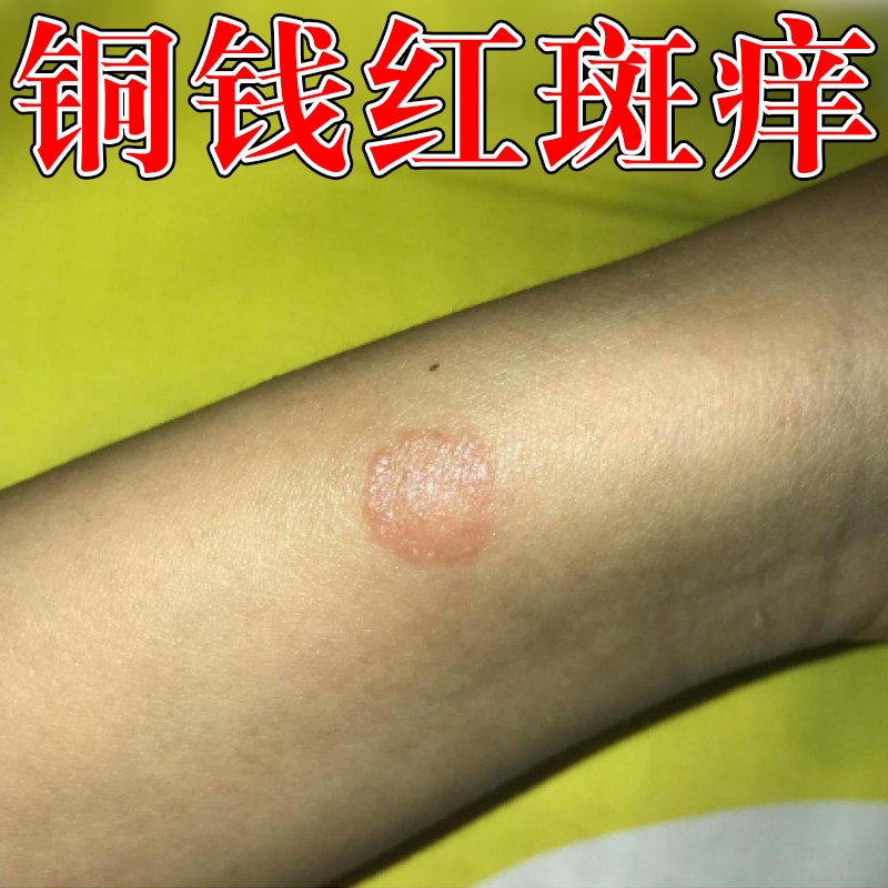 铜钱红斑痒皮肤干燥粗糙起皮掉屑金钱真菌手臂过敏长小疙瘩痒乳膏
