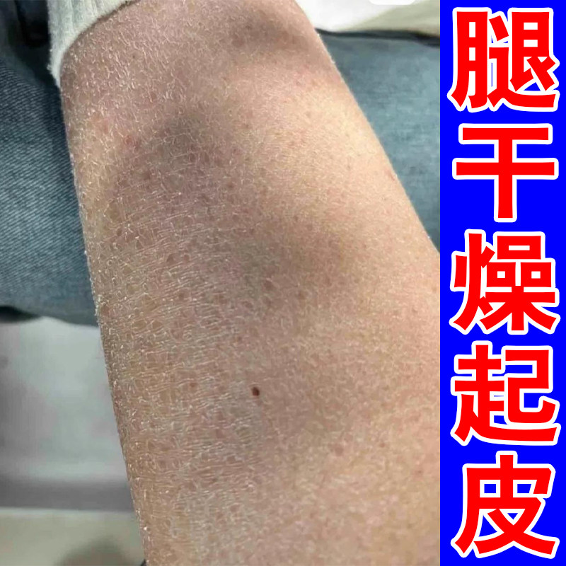 小腿秋冬天皮肤干燥粗糙起皮掉屑腿部干纹起白屑鱼鳞皮肤干痒保湿