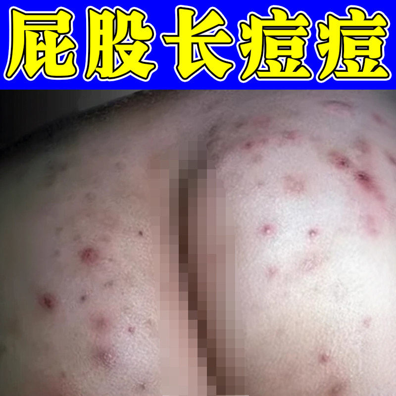 屁股长痘痘药红肿疙瘩股大腿内侧痒红斑久坐板火疖子小红点痒软膏