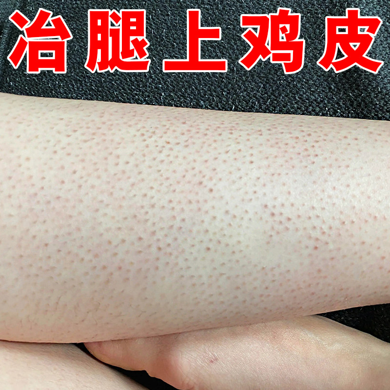 夏季腿上起鸡皮粗糙小黑点疙瘩小腿手臂干燥毛囊疙瘩外用