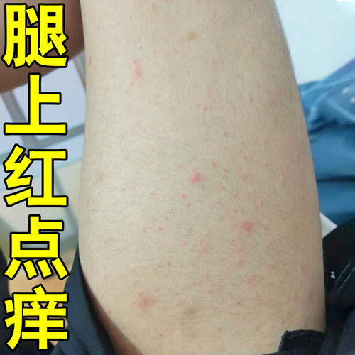 腿上红点皮肤干痒长小疙瘩专用身上痒起红疙瘩干燥粗糙小腿痒软膏