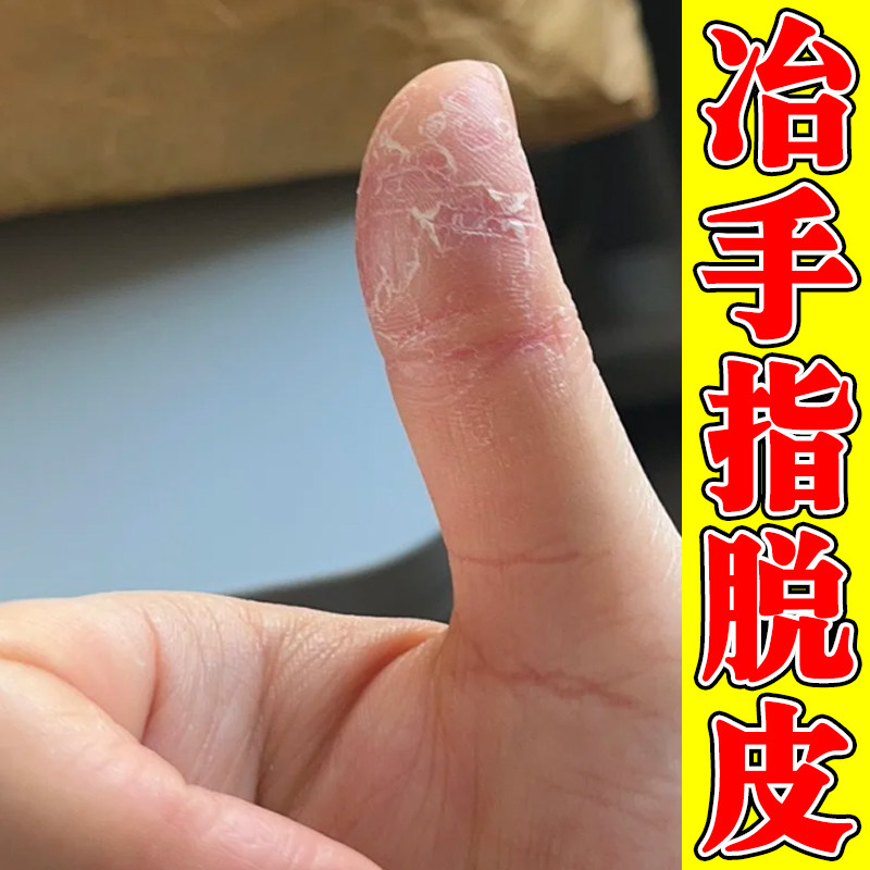 冶手指脱皮的药手干燥粗糙起硬皮去死皮手蜕皮掉屑外用修复软膏