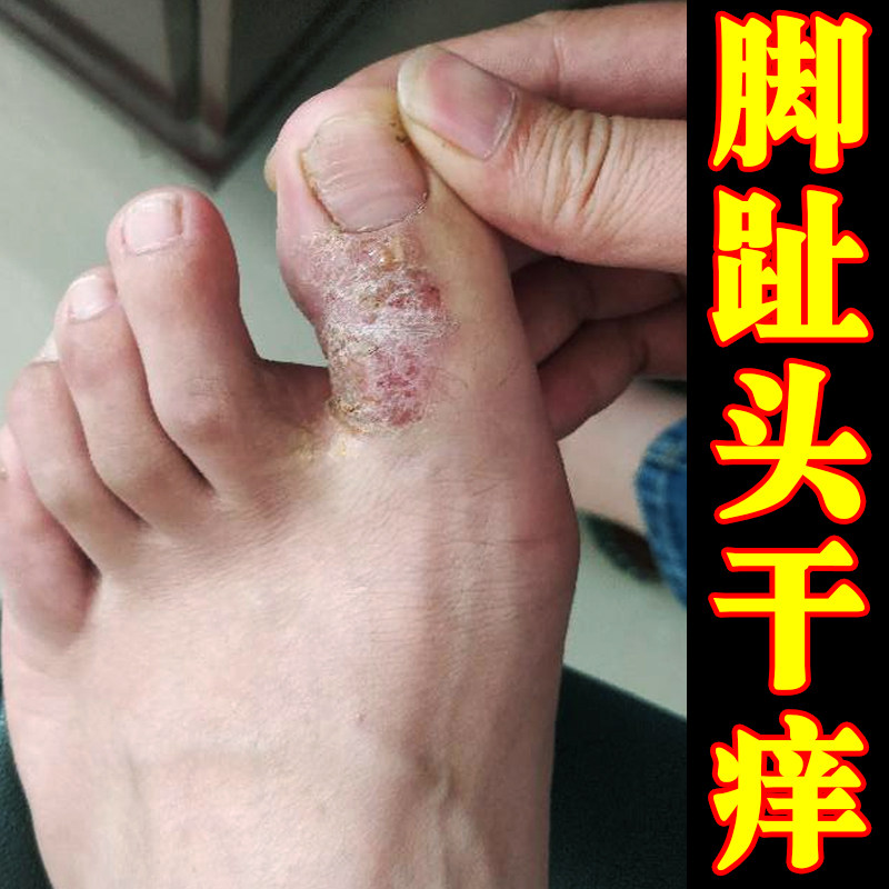 脚趾头干痒长小水泡真菌红斑脚背脚面脚指头关节干燥粗糙发痒软膏