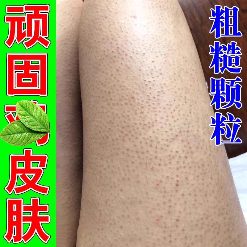 皮肤疙瘩毛囊腿上毛囊粗糙小颗粒皮肤凸起小黑点腿部大腿小疙瘩药