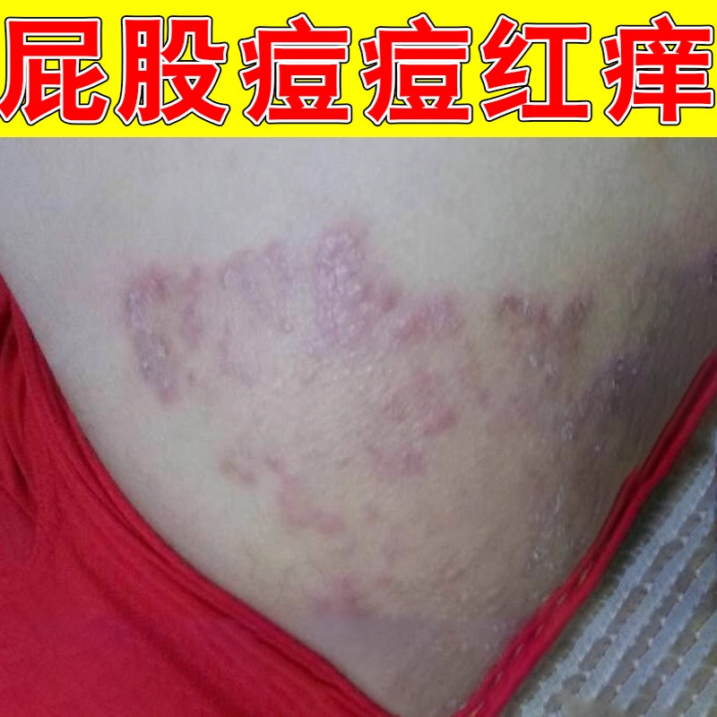 屁股长痘痘红痒疙瘩大人久坐屁股私处大腿内侧痒红斑干燥粗糙专用