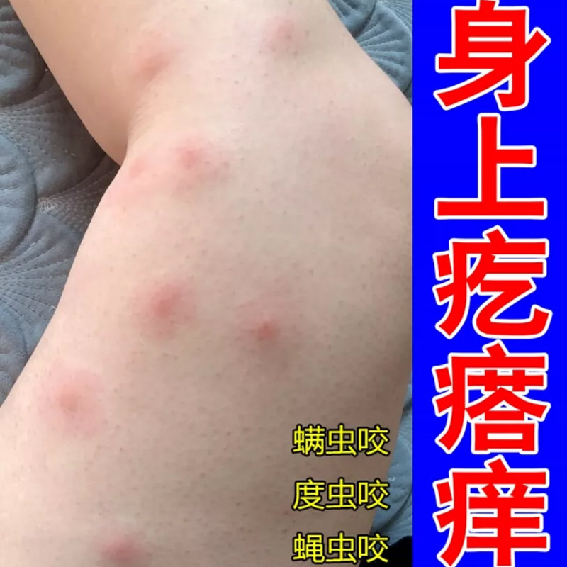 身上疙瘩痒蚊虫叮咬跳蚤咬虫咬性过敏丘疹红肿痘痘床虱疥螨专用膏
